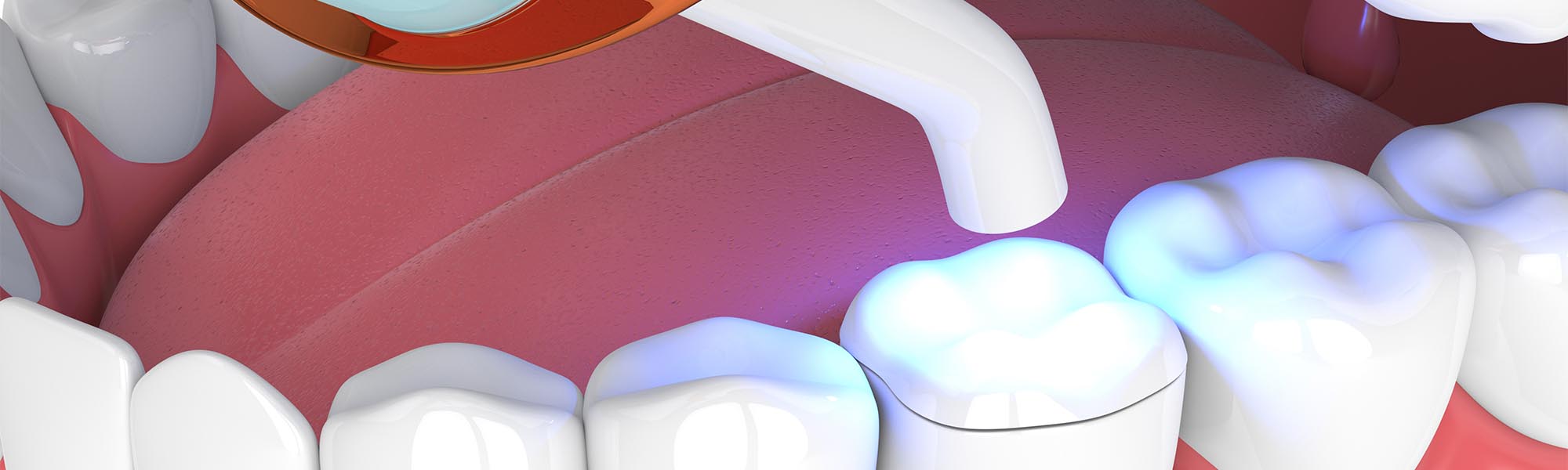 Porcelain Inlays & Onlays Dentist in Whittier CA