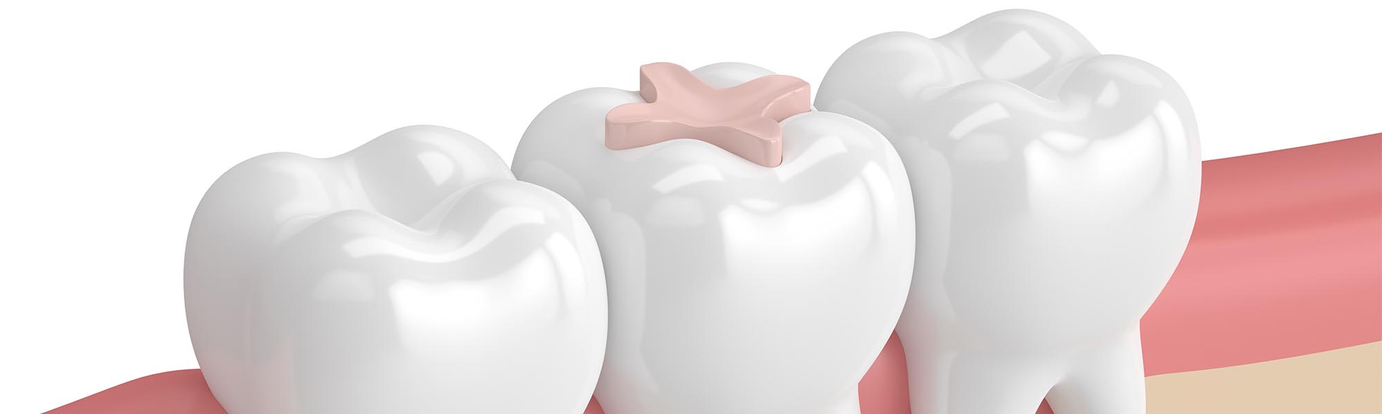 Restorative Inlays & Onlays in Whittier CA