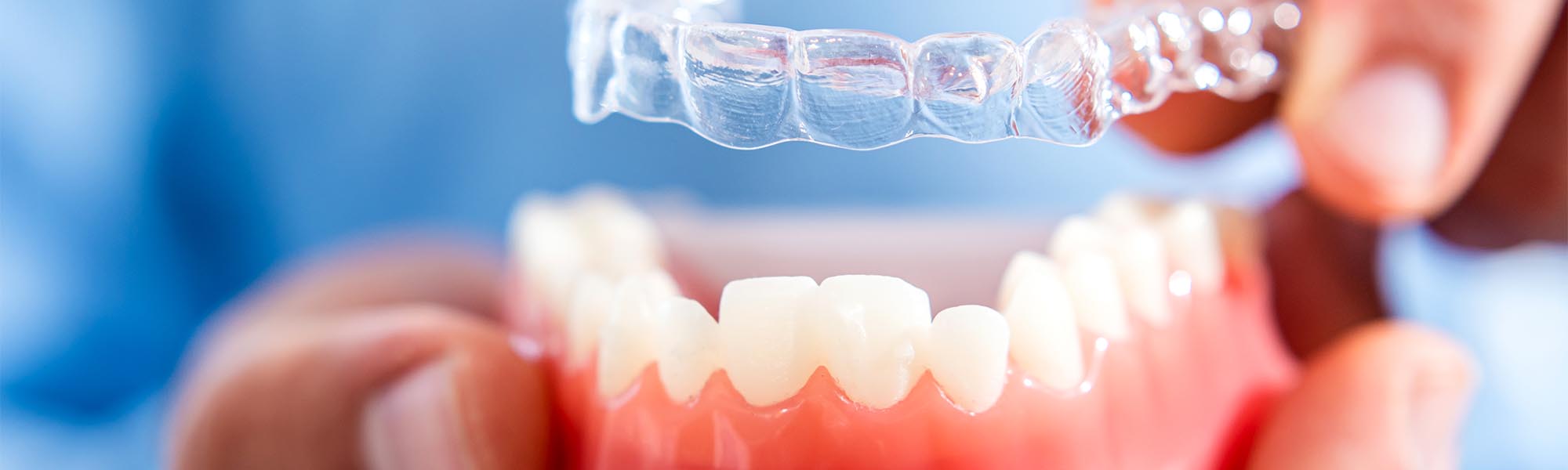Invisalign® Whittier CA
