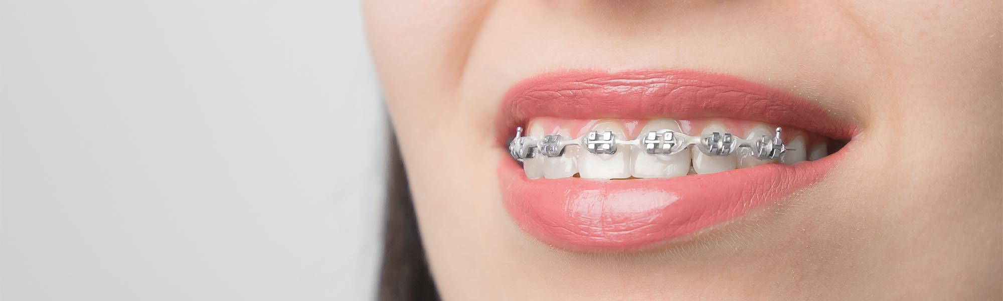 Metal Braces in Whittier CA