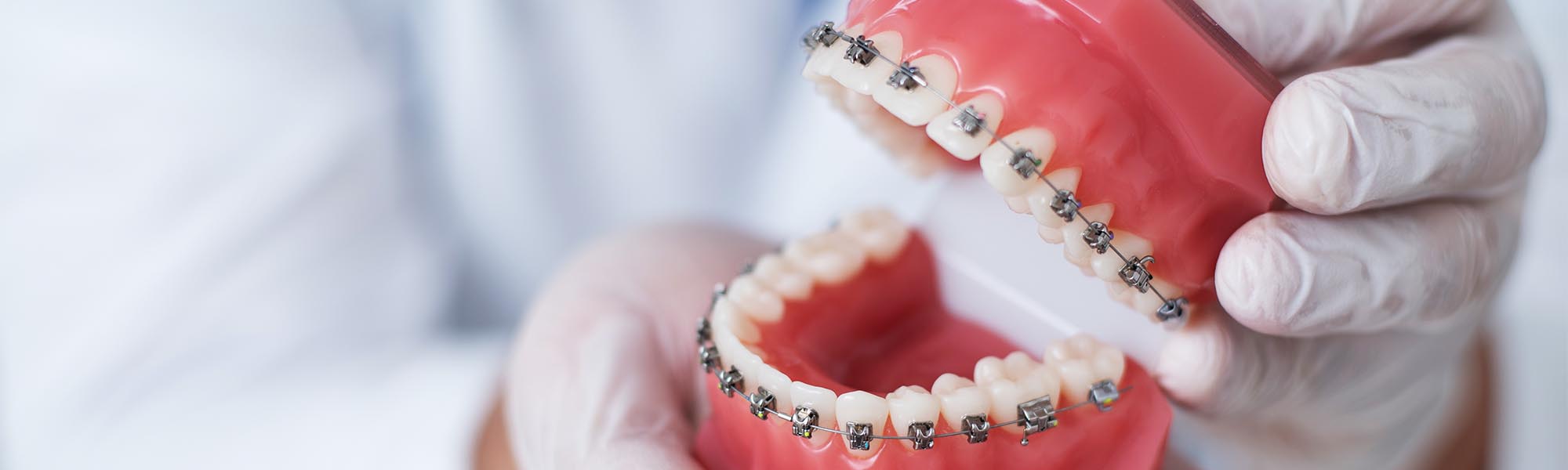 Metal Braces Whittier CA
