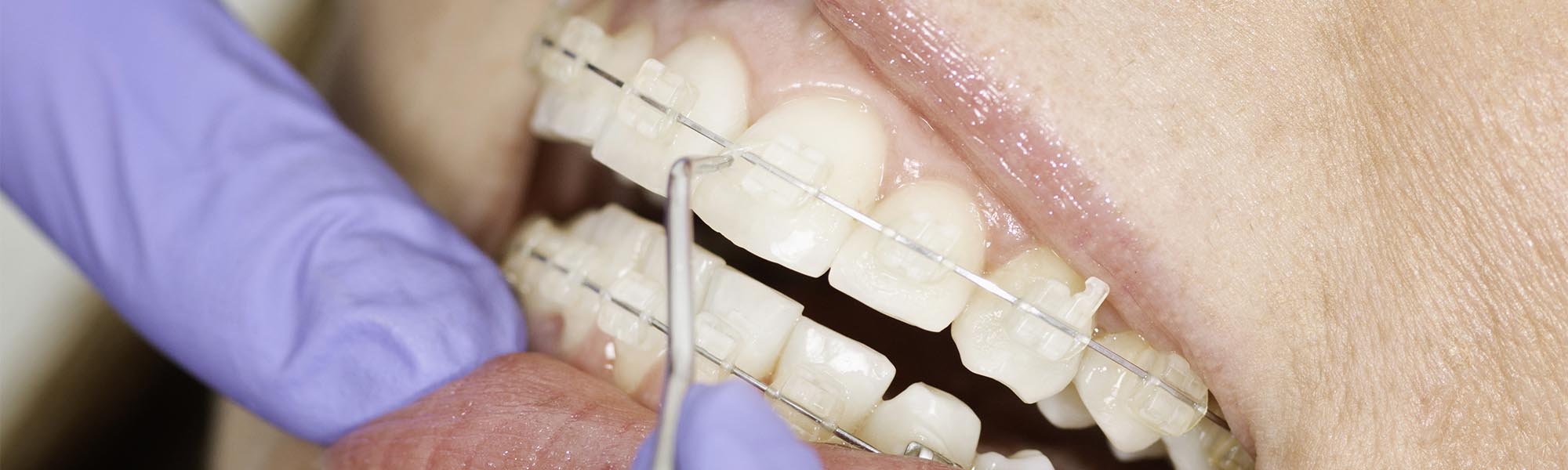 Porcelain Ceramic Braces Dentist Whittier CA