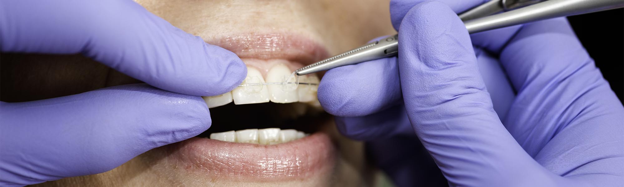 Porcelain Ceramic Braces in Whittier CA