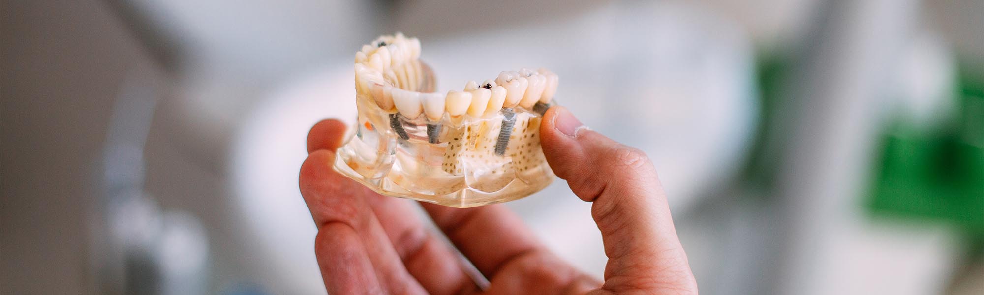 Multiple Teeth Implants Whittier CA