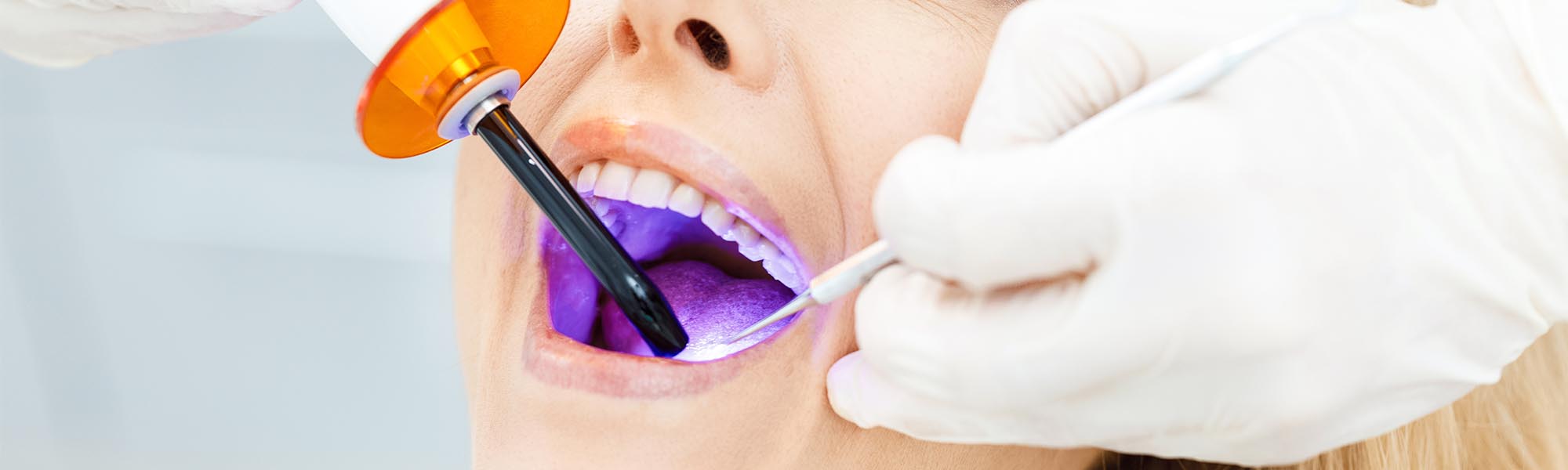 Dental Sealants in Whittier CA