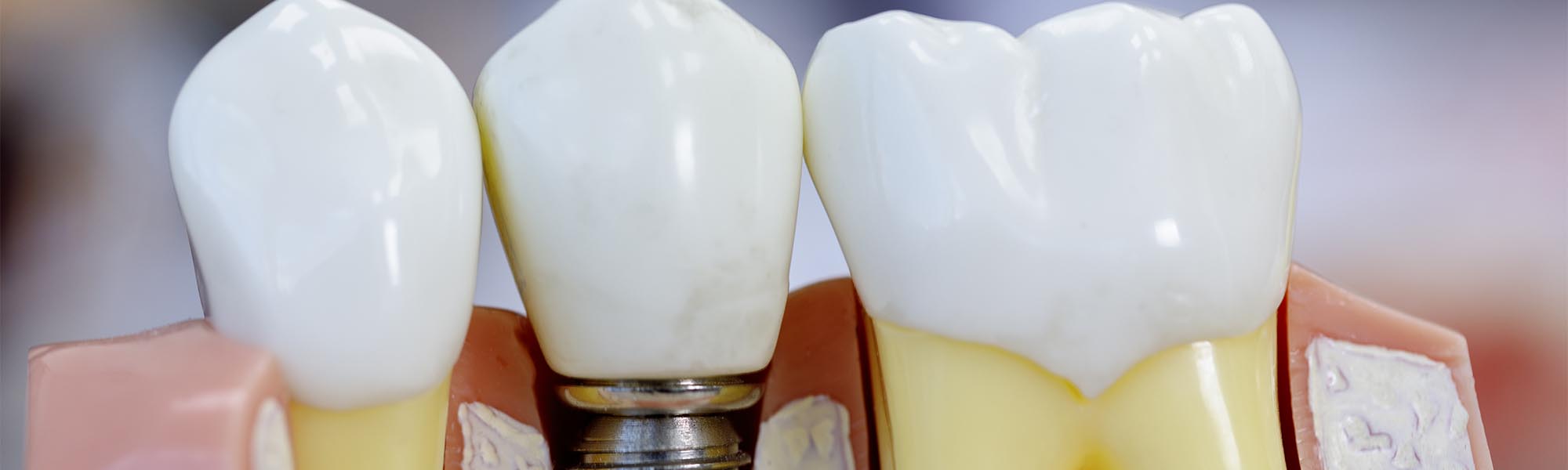 Single Tooth Implants Whittier CA